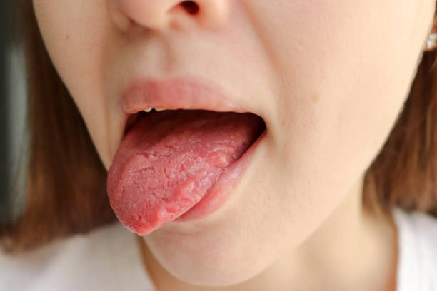 istock Tongue problems. Woman with geographical tongue. Migratory glossitis 2187106061