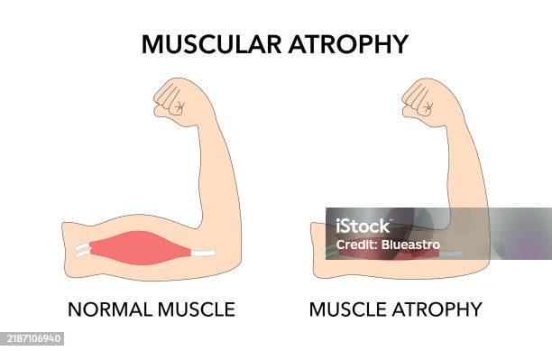 Abnormal Strength Muscular Atrophy Compared To Healthy Outline Diagram Weakness Abnormal ...