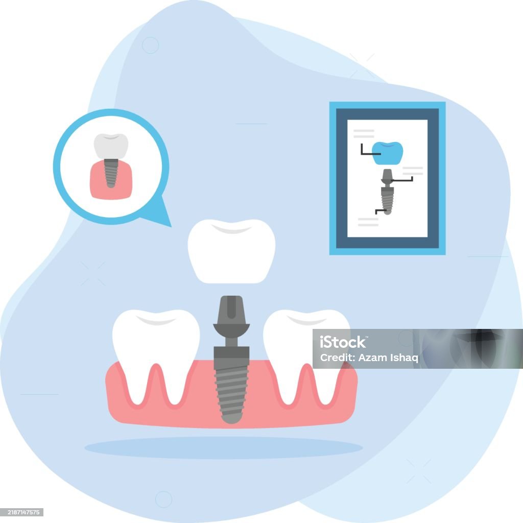 Replacing One Missing Teeth Using Dental Implant Concept Permanent ...