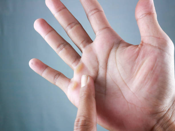 istock closeup of fingers shows callus hands from working hard 2187450015