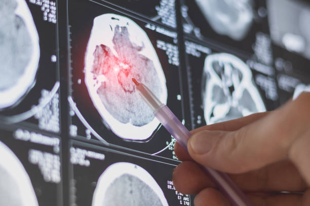 istock Brain computed tomography (CT) scan of a patient. Learning head diseases. 2187469741