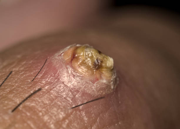 istock The sore on the toe joint has completely hardened 2187697180