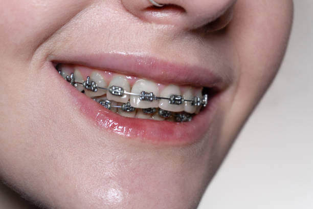istock Metal braces and bright teeth: A close-up emphasizing clean teeth and the intricate structure of orthodontic braces. 2187738070