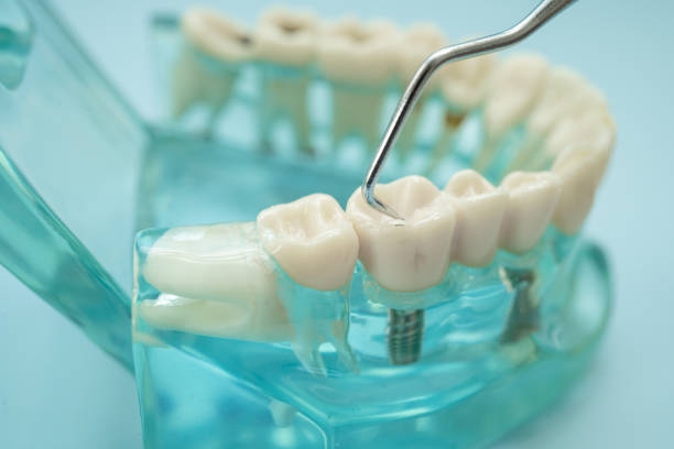 istock Dental teeth model with dentist tool for dentistry. 2187782781