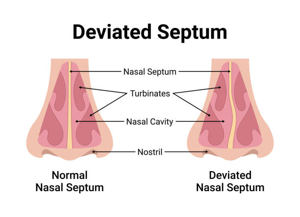 Deviated Nasal Septum Medical Vector Illustration It's perfect for medical presentations, educational materials, and healthcare projects, providing a clear understanding of this common condition. septum stock illustrations