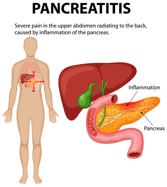 istock Illustration of pancreas inflammation and related pain 2188155356