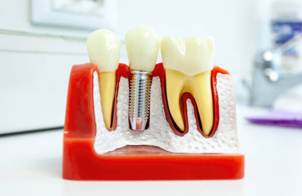 istock Dental implant model showing teeth, gums and bone structure 2188353730