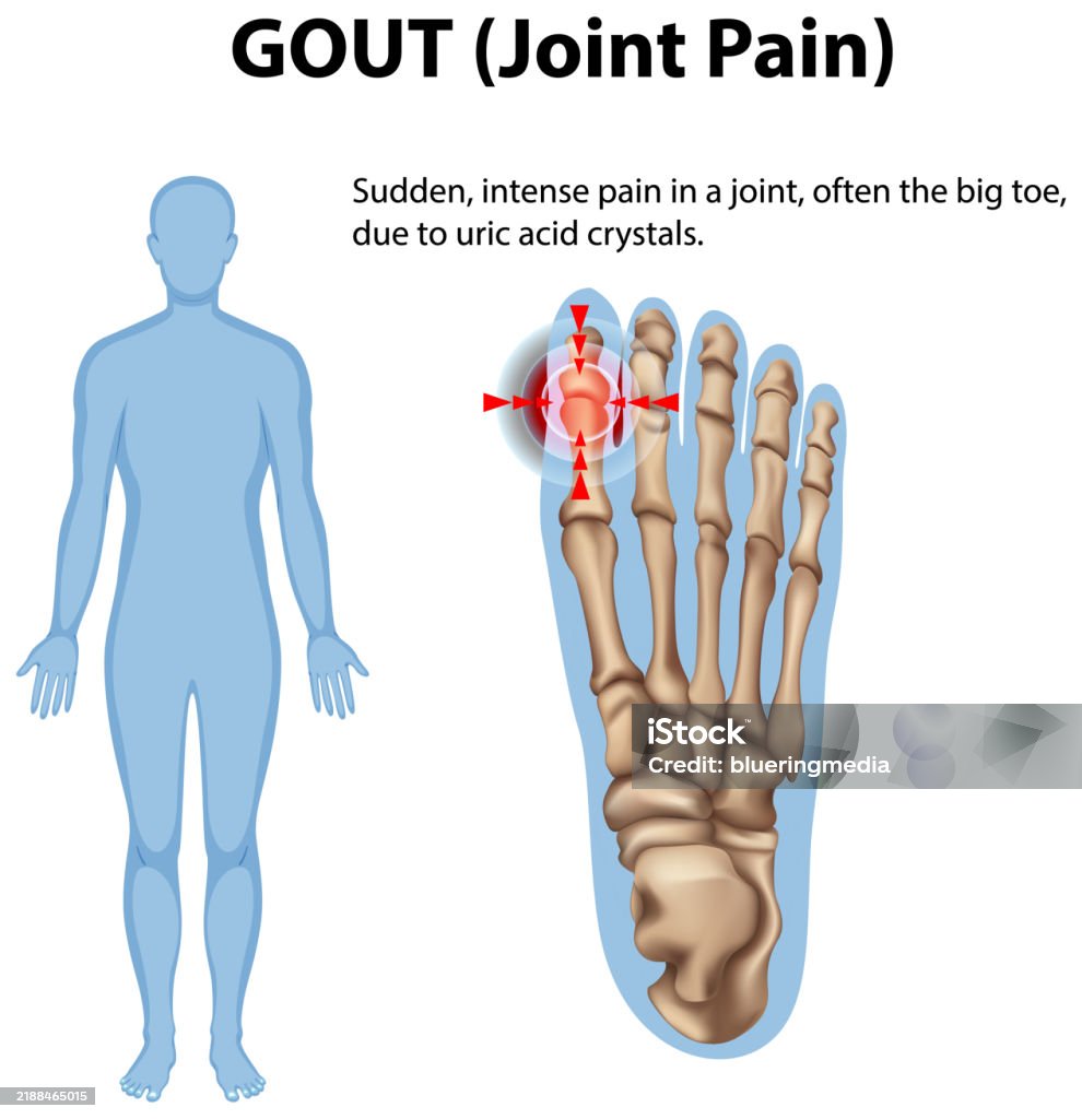 Got Toe Illustration Of Gout Affecting The Human Foot Joint Stock Illustration ...