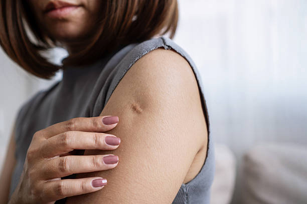 istock monkeypox and smallpox vaccine scar on woman's arm 2188493906