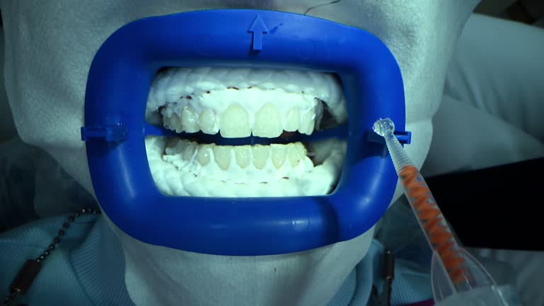 Dental Whitening process in patient mouth. Teeth whitening with UF Lamp, Led Lamp and gel. Dental Extreme Close up Macro Video. Concept of professional dental hygiene. 4k 120 fps slow motion footage