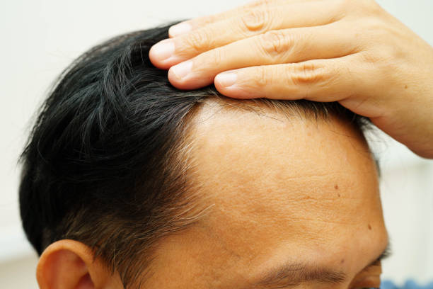 istock Bald head in man, hair loss treatment health problem. 2188508414