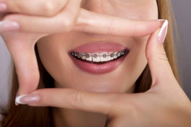 istock Smiling woman with metal braces on her teeth making a frame with her hands 2188740164