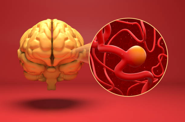 Cerebral aneurysm - 3d illustration isometric view stock photo