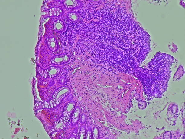 istock Ulcerative colitis photomicrograph in anatomical pathology laboratory 2188935121