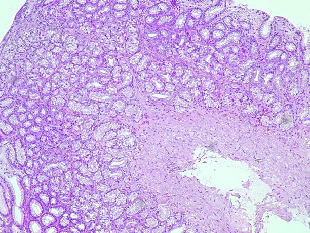 istock Human cell tissue under microscope in pathology laboratory. Microscopic picture of chronic gastric disease showing Helicobacter pylori bacterial infection, hematoxylin eosin staining 2188935743