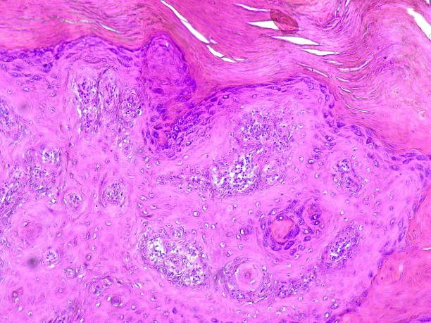 istock Photomicrograph of chronic osteomyelitis under a microscope in a pathology laboratory 2188935776