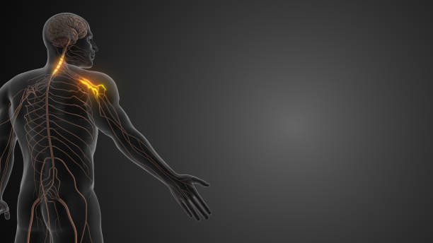 Cervical radiculopathy refers to a condition where a nerve in the neck (cervical spine) becomes compressed or irritated, leading to pain, numbness, and weakness that can radiate down the arm, essentially impacting both the neck and arm nerves due to the affected nerve root originating in the neck area. it's often described as a \