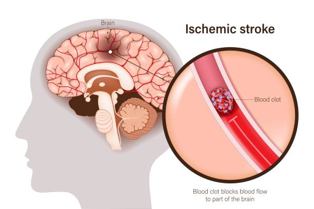 istock Ischemic stroke vector. Blood clot blocks blood flow
to part of the brain. Thrombosis. Brain tissue death. 2188973584