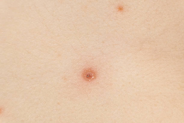 istock Macro skin with chickenpox, vesicles at different stages. 2189019695
