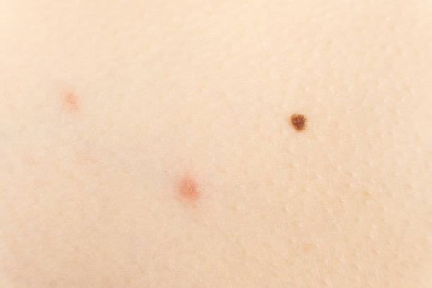 istock Comparison of chickenpox rashes and nevus on human skin 2189019696