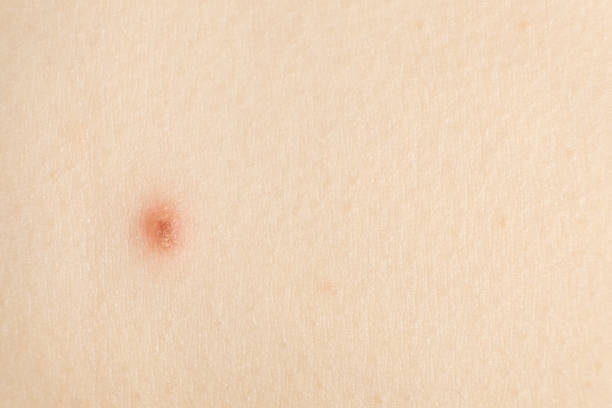 istock Macro skin with chickenpox, vesicles at different stages. 2189019805