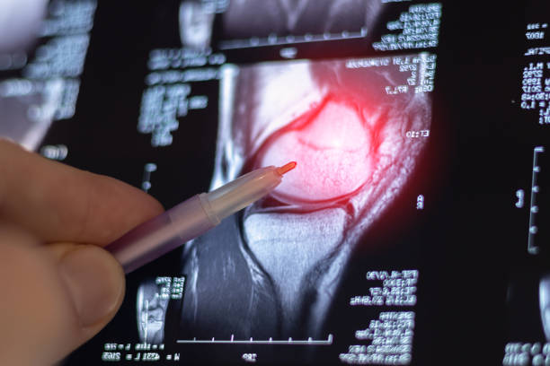 istock Doctor learning Knee joint MRI. Assessing ligaments, cartilage, and identifying issues like tears or inflammation. 2189171821