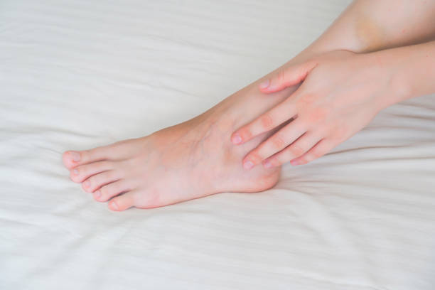 istock Close up view on woman's leg with varicose vein 2189362215