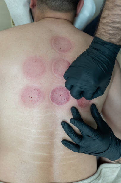 istock Therapist placing suction cups on patient's back for cupping therapy session 2189571523