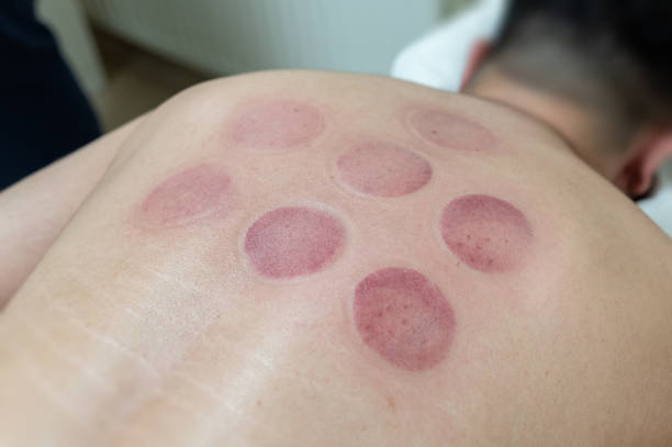 Chinese traditional Chinese medicine treatment technique cupping