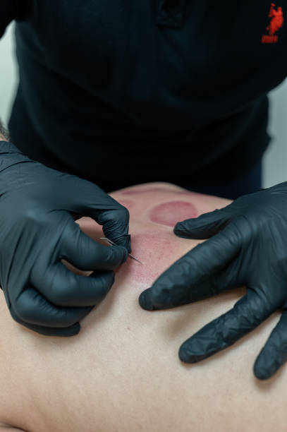 istock Doctor performing dry needling therapy on patient's back 2189571635