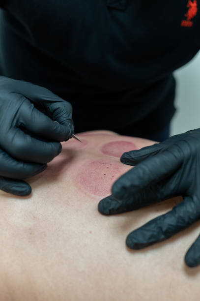 istock Doctor performing cupping therapy on patient's back for pain relief 2189571772