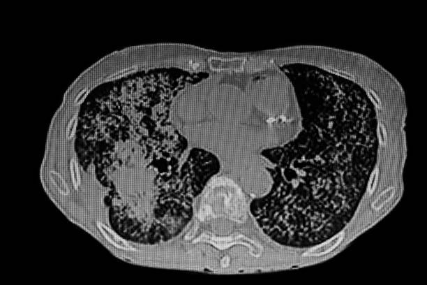 istock Chest CT Scan of lung cancer (Adenocarcinoma) with  miliary pattern. 2189950238