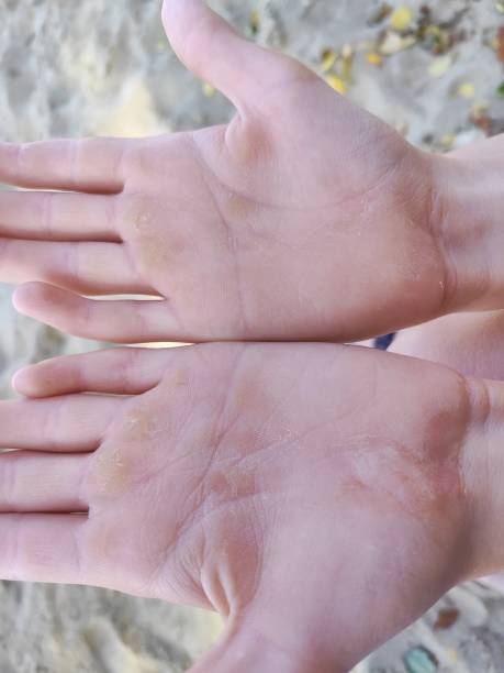 istock Child's hands with simian crease 2189960454