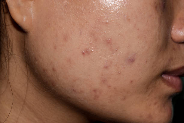 istock Acne vulgaris, black spots and scars on the face 2190174906