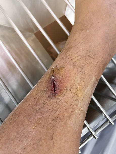 istock Inflamed shin wounds 2190181807