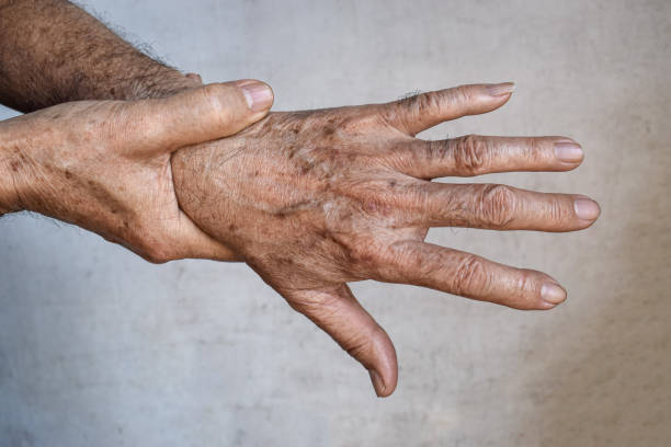 istock Age spots on hands. They are brown, gray, or black spots and also called liver spots, senile lentigo, solar lentigines, or sun spots. 2190257817