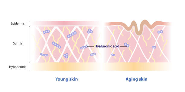 Comparison of Hyaluronic acid levels decrease with age in dermis vector illustration. Comparison of Hyaluronic acid levels decrease with age in dermis vector illustration. Cross section of young and aging skin with hyaluronic acid molecule. Skin care and beauty concept. broken skin stock illustrations