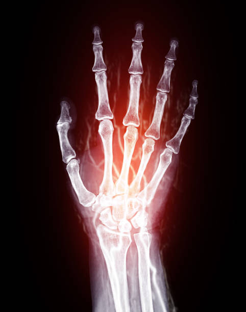 istock X-Ray and Vascular Imaging of Hand:This image combines X-ray bone structure with glowing red vascular pathways, showcasing detailed blood flow and skeletal anatomy. 2190389982