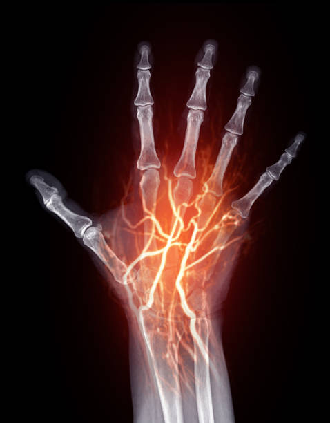 istock X-Ray and Vascular Imaging of Hand:This image combines X-ray bone structure with glowing red vascular pathways, showcasing detailed blood flow and skeletal anatomy. 2190390408