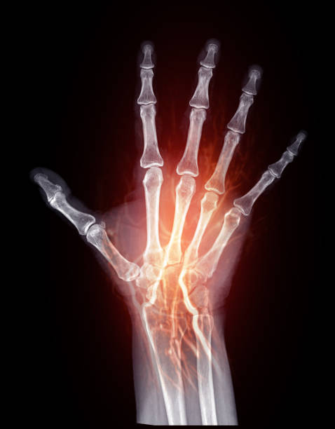 X-Ray and Vascular Imaging of Hand:This image combines X-ray bone structure with glowing red vascular pathways, showcasing detailed blood flow and skeletal anatomy.