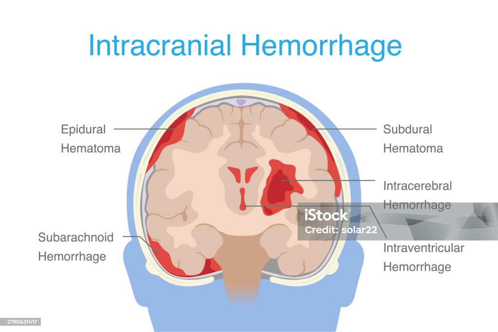 Ilustración de Hemorragia Cerebral De 4 Tipos Incluida La Hemorragia ...