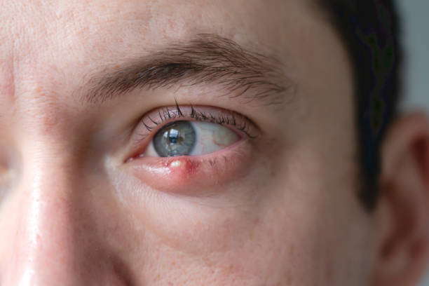 istock Man with infected chalazion (stye, barley) eye on lower eyelid 2190656628