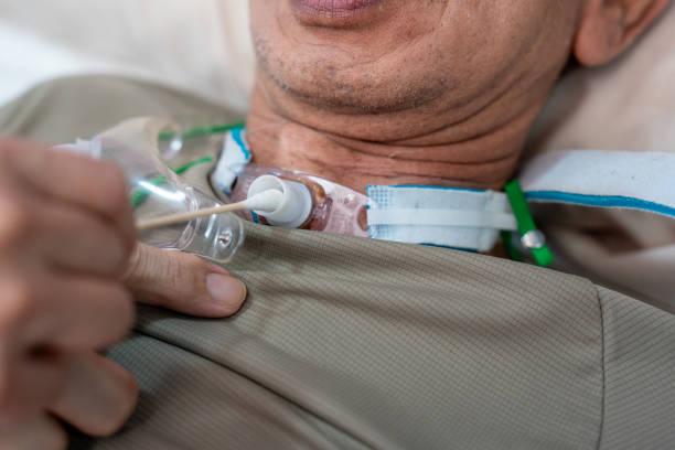 istock Patients who have undergone a tracheostomy for intubation 2190784402