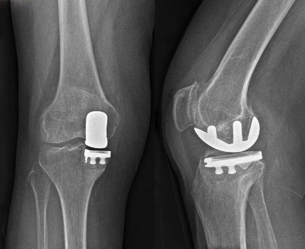 Partial Knee Replacement X-Ray stock photo