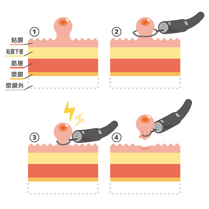 Polypectomy Scars Illustration Of Endoscopic Treatment Polypectomy Stock Illustration ...
