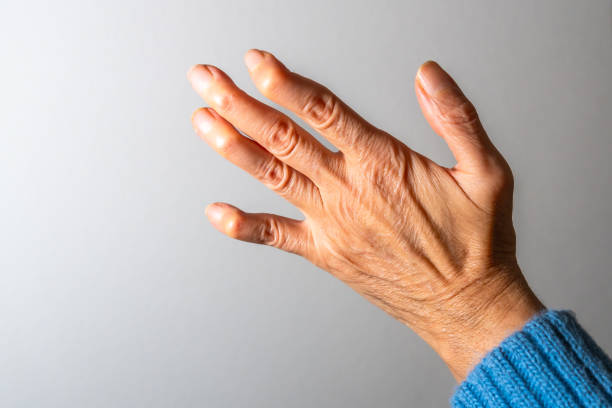istock Senior woman showing her hand affected by arthritis 2191155229