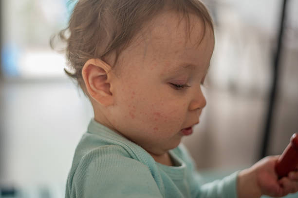 istock Baby with skin rash - exanthem 2191240436