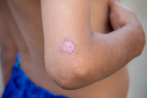 istock Close-Up of Skin Lesion on Elbow 2191820114