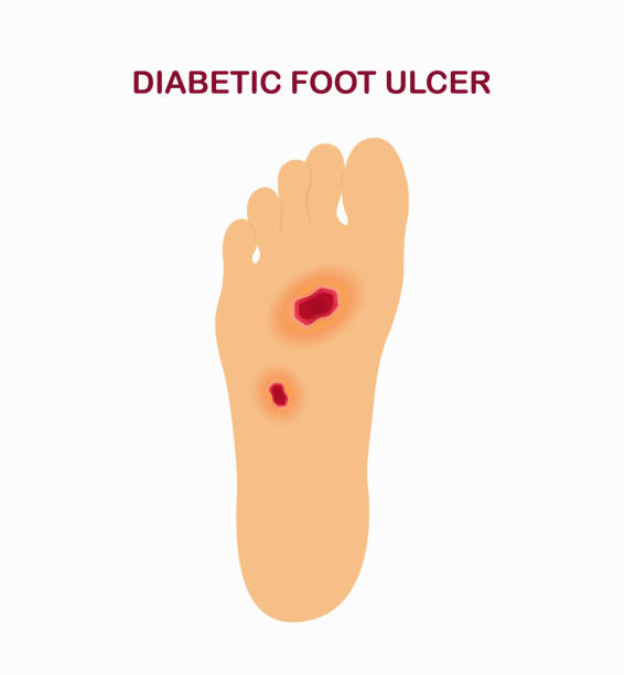 diabetické vředy na nohou. plovásek nohy s kožními vředy a vředy - noha část těla stock ilustrace