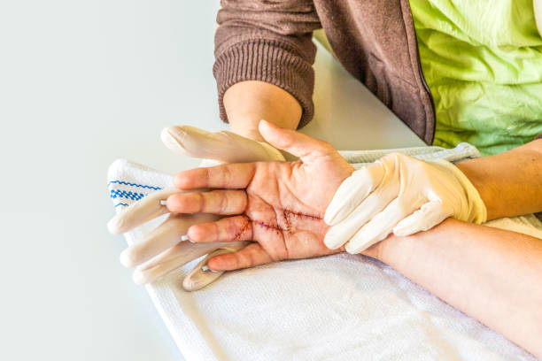 istock hand physiotherapy to recover a broken finder 2191927342